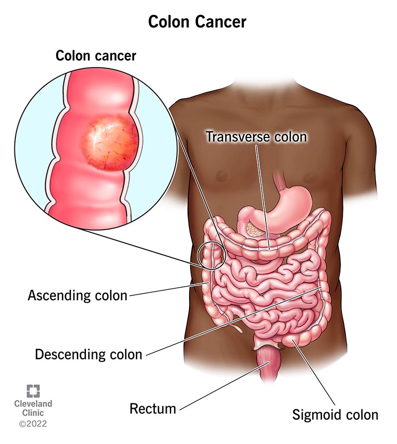Stage 4 colon cancer symptoms may include unexplained weight loss, blood in stool, abdominal pain, and fatigue. These signs can indicate advanced cancer progression.