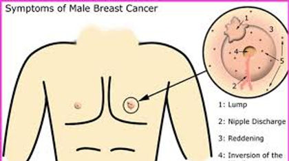 Breast cancer symptoms in men may include lumps, changes in nipple appearance, skin dimpling, and nipple discharge. While breast cancer is more common in women, men can also develop this disease.