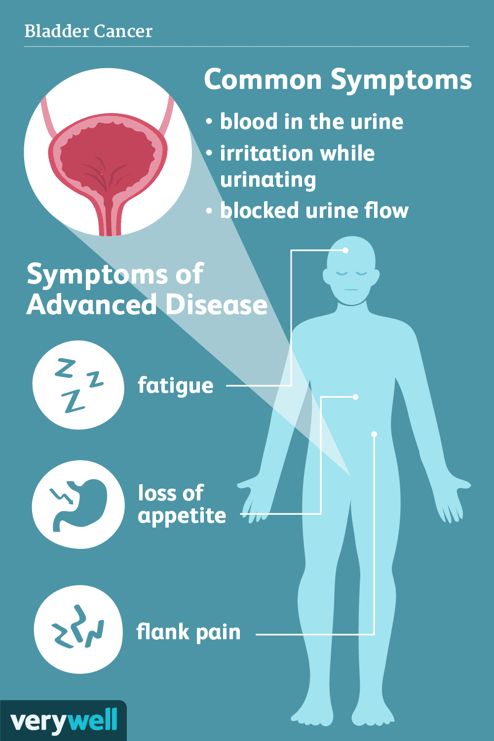 Advanced bladder cancer symptoms include blood in urine, pelvic pain, frequent urination, and back pain. These signs indicate a need for prompt medical evaluation to determine appropriate treatment.