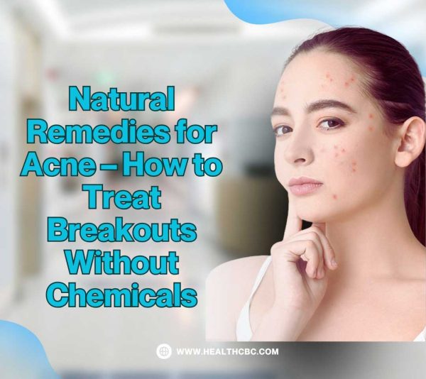 Natural Remedies for Acne – How to Treat Breakouts Without Chemicals