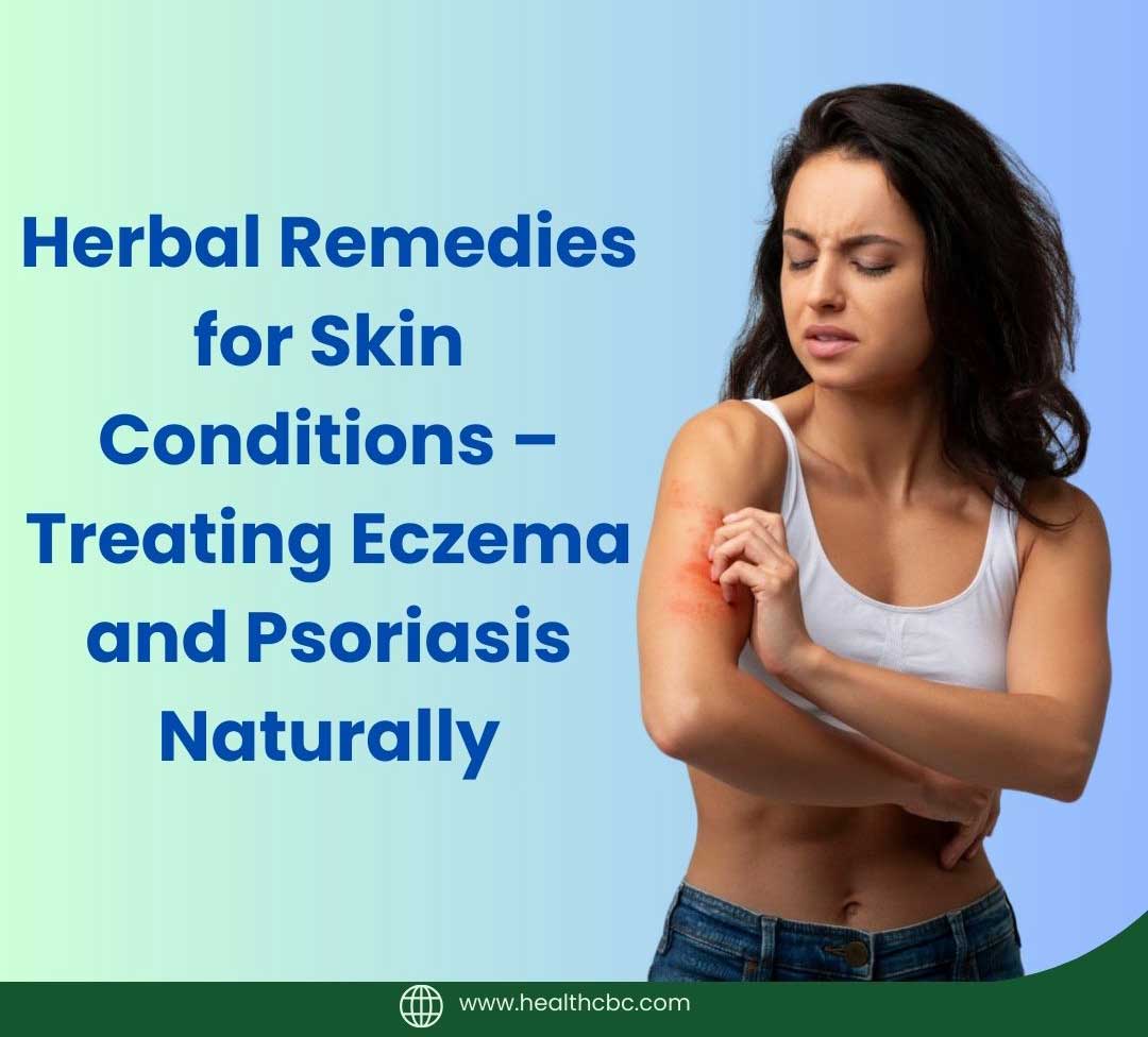 Herbal Remedies for Skin Conditions – Treating Eczema and Psoriasis Naturally